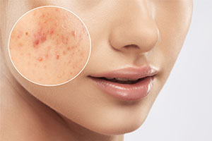 NL_PersonalCare_2025-01_Labio-Anti-Acne_thumbs